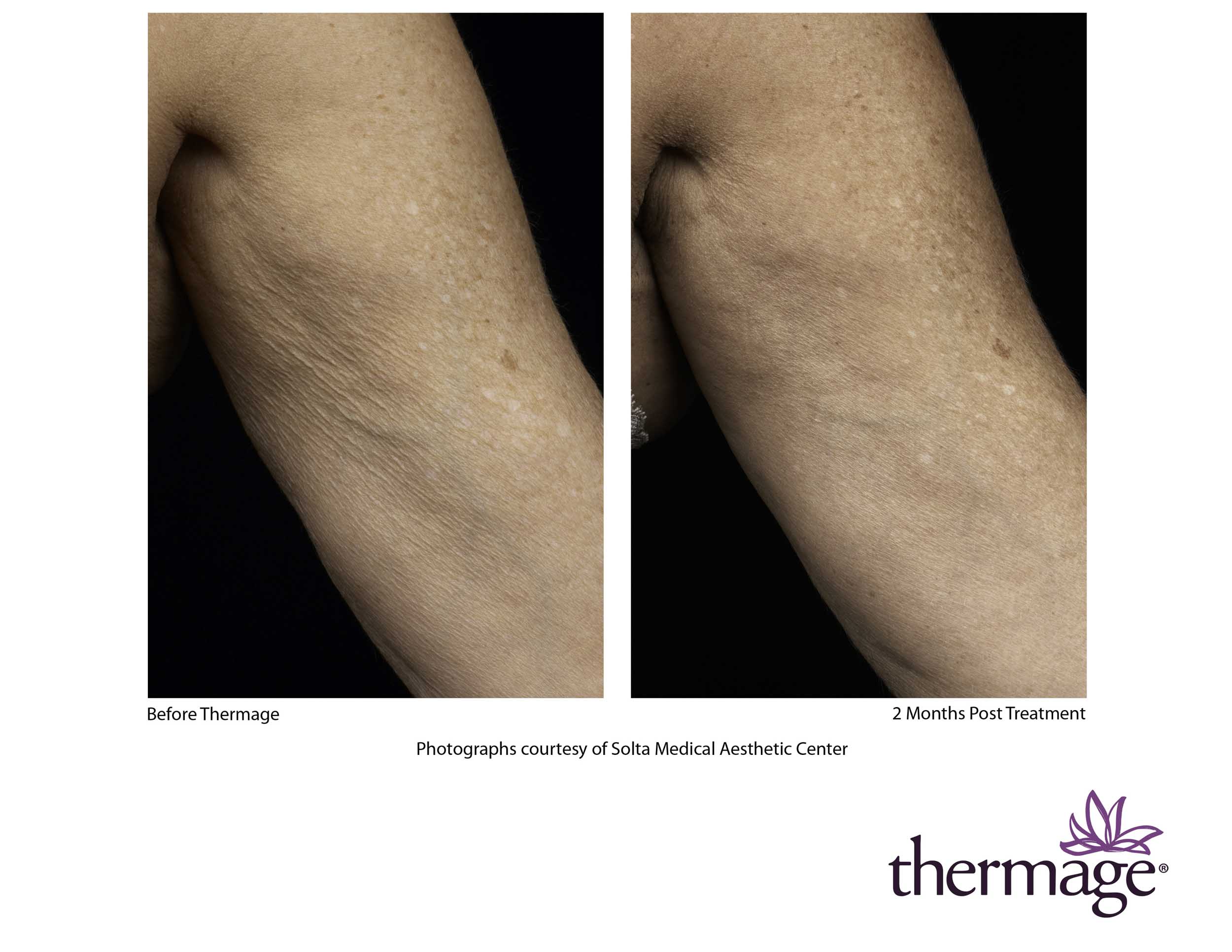Before and after Thermage treatment on arm in Charlotte