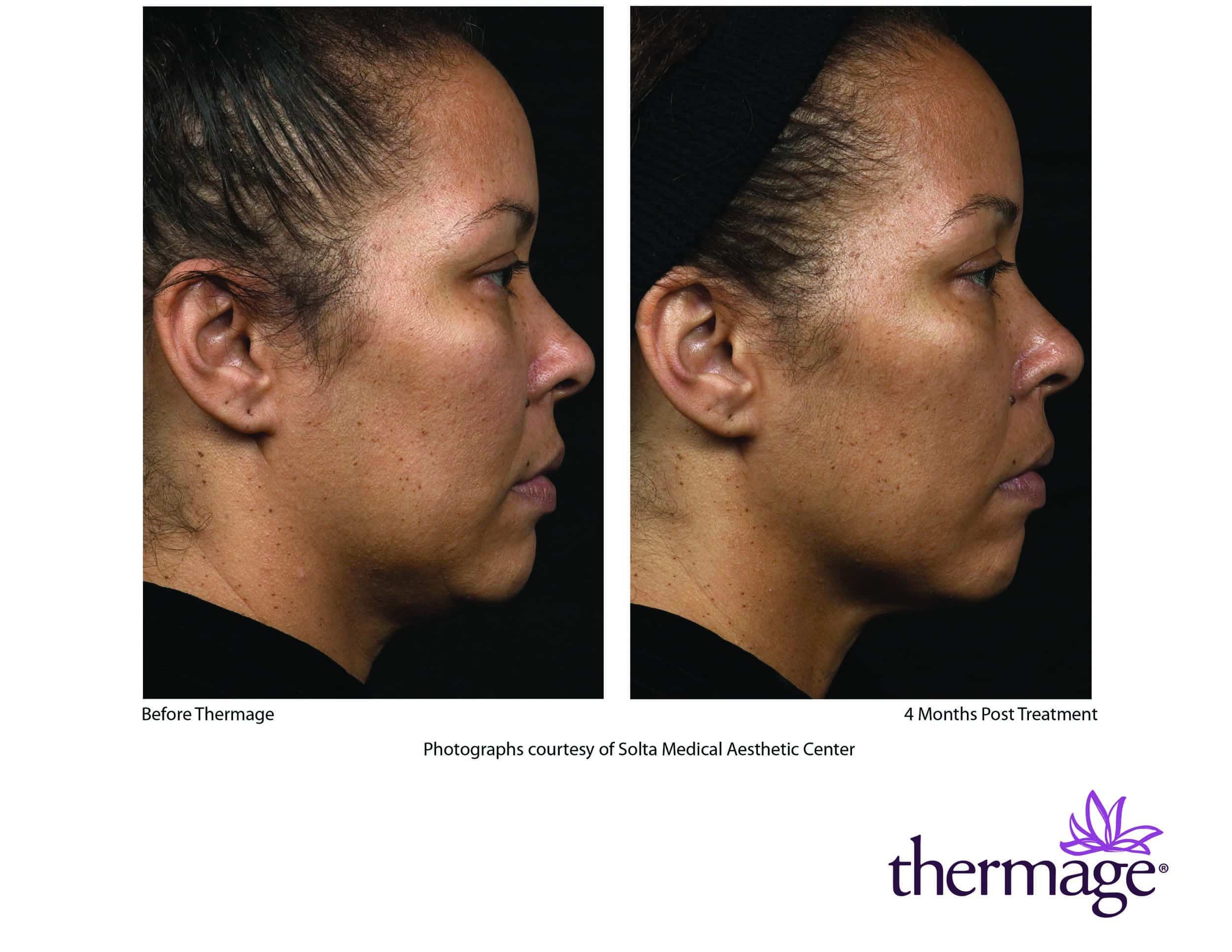 Before and after Thermage treatment on face in Charlotte