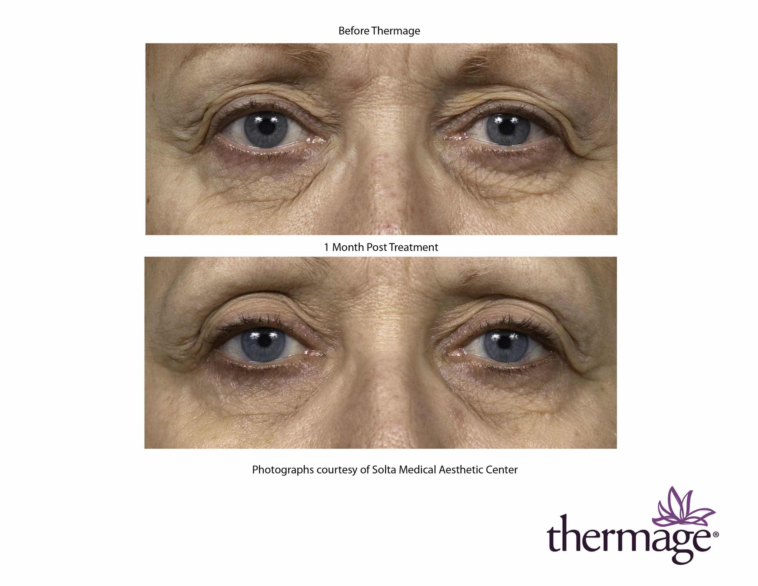Before and after Thermage treatment around eyes in Charlotte