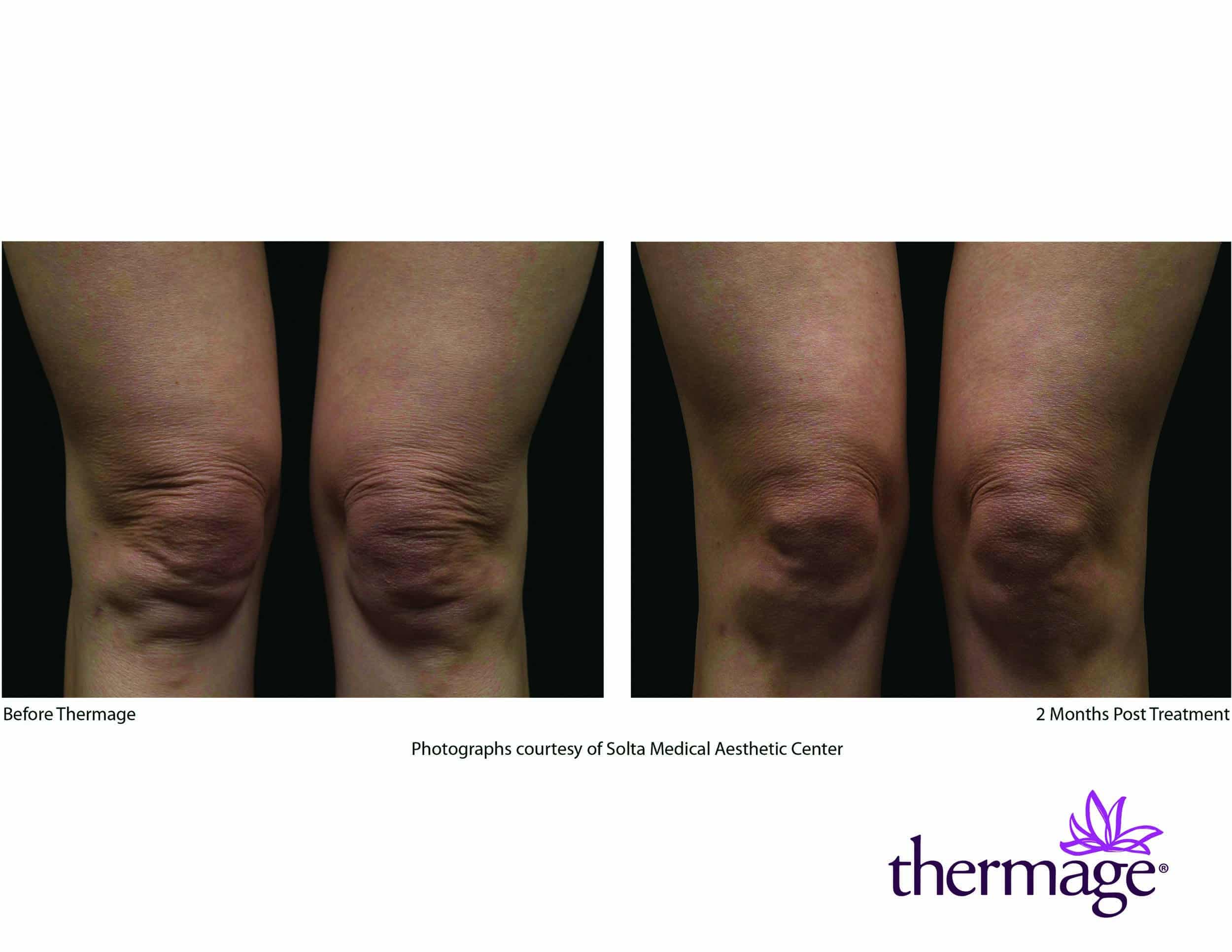 Before and after Thermage treatment on knees in Charlotte