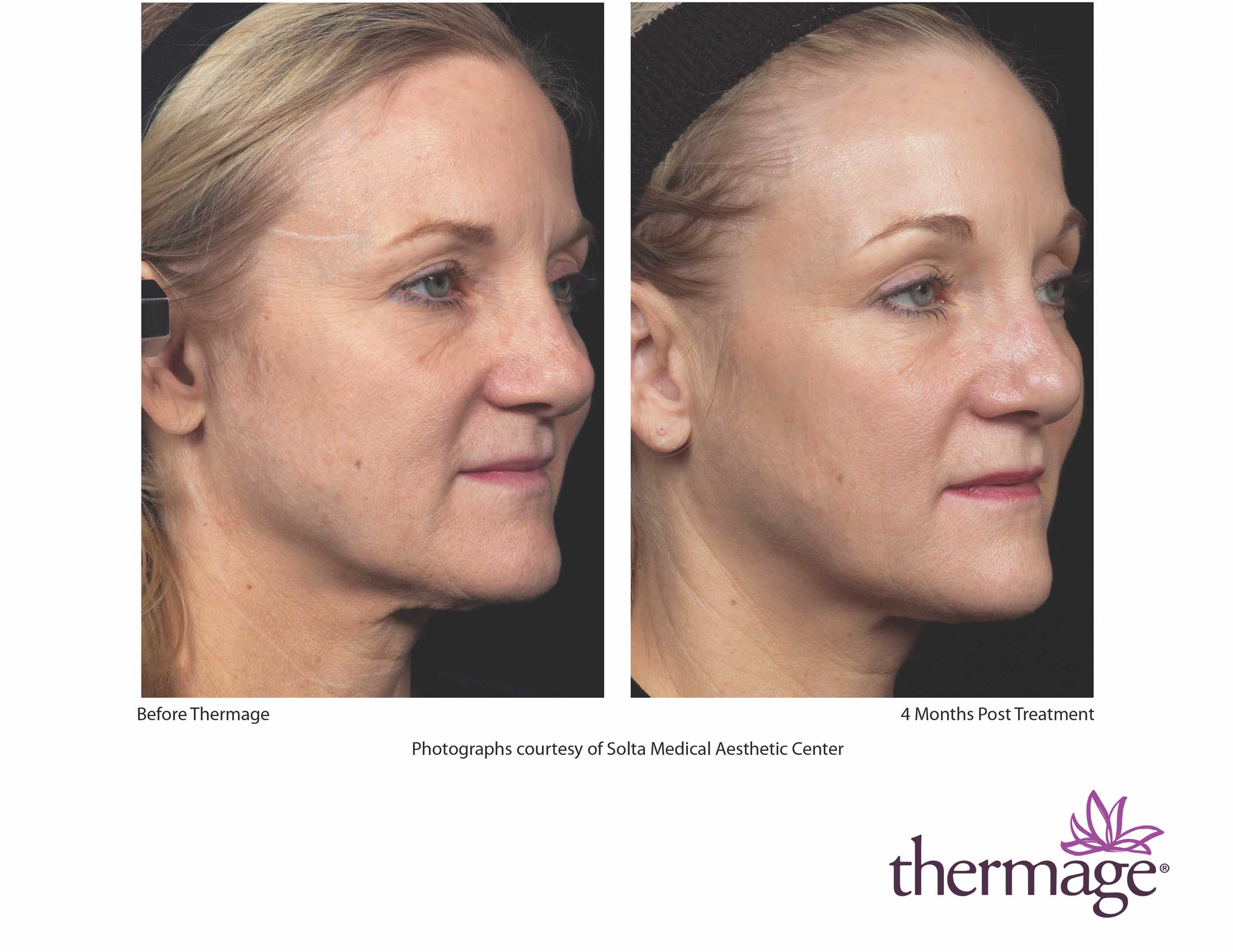 Before and after Thermage treatment in Charlotte