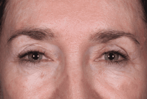 After Daxxify treatment wrinkles on the brow