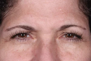 After Daxxify treatment wrinkles on the brow