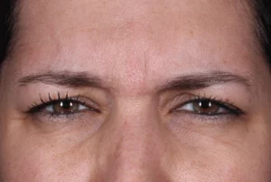 Before Daxxify treatment wrinkles on the brow